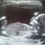 Our little girl on the way
