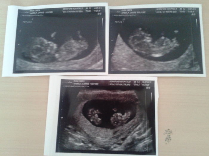 Scan pictures at ten weeks