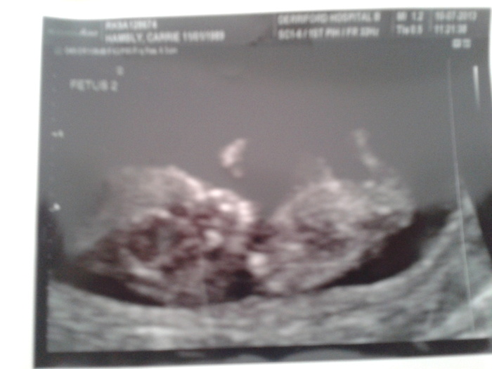 Baby Numero 2 (10 Weeks)