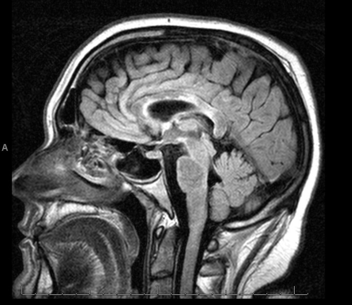 Brain MRI 7/26/2013