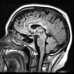 Brain MRI 7/26/2013