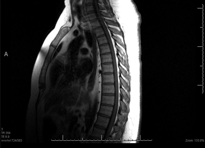 T Spine MRI 7/27/2013