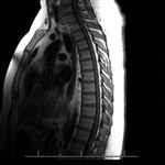 T Spine MRI 7/27/2013