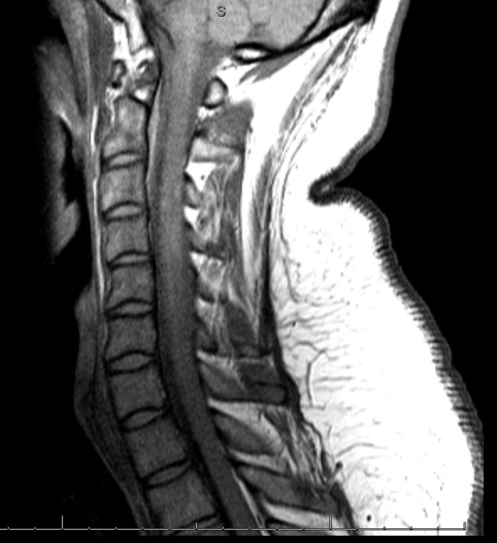 C Spine MRI 7/27/2013