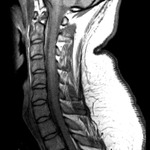 C Spine MRI 7/27/2013