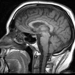 Brain MRI (pic 2)  7/26/2013