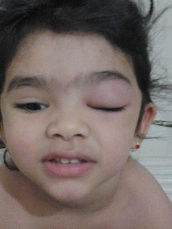 2.5 year old daughter with swollen eyes