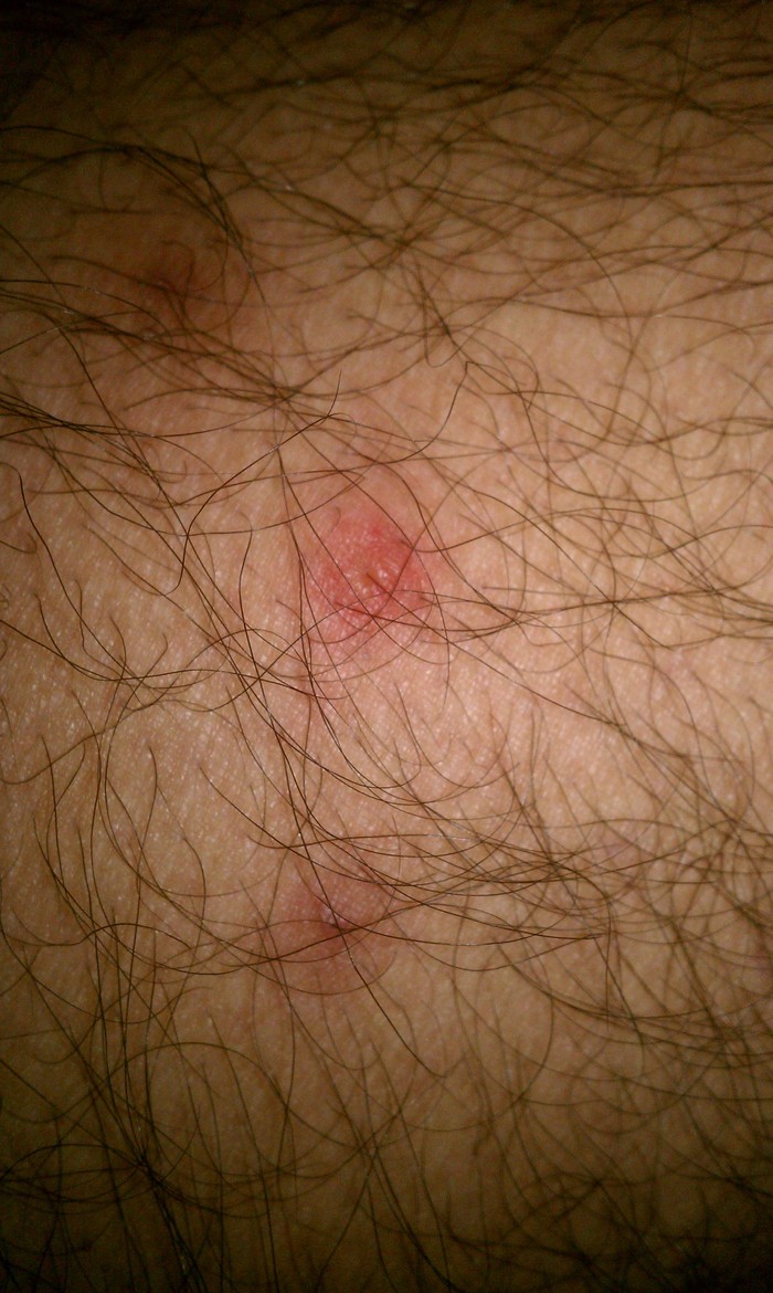 red rash on the thigh