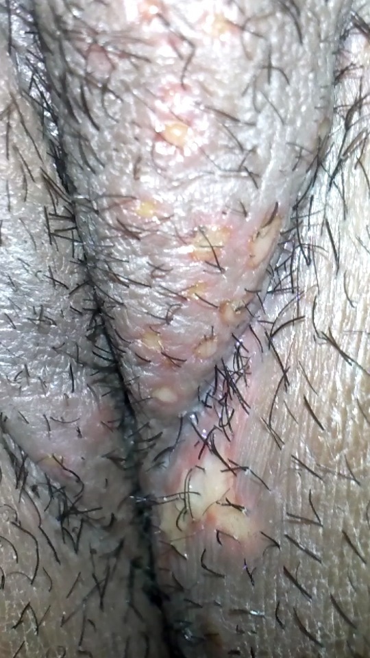 Sores after shaving and Having sex