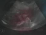 our lil guy covering his face. weighin in at 13 oz. and we are 22weeks and 4 days...