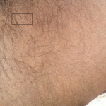 Another image of the same inner thigh spot from another angle