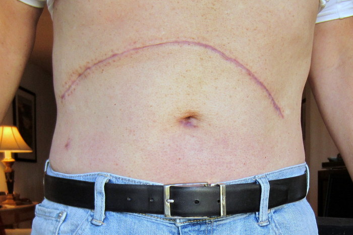 My transplant incision and hernia repair 3 months post