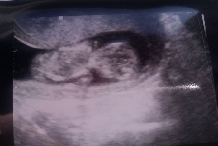 little miracle at 11w4d