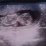 little miracle at 11w4d