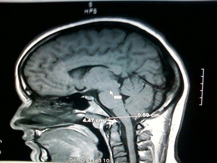 Brain MRI