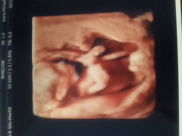 My baby boy holding the umbilical chord!