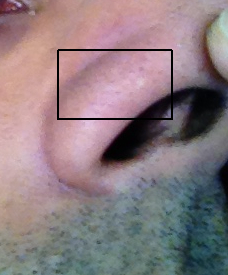 Clearer nose spot
