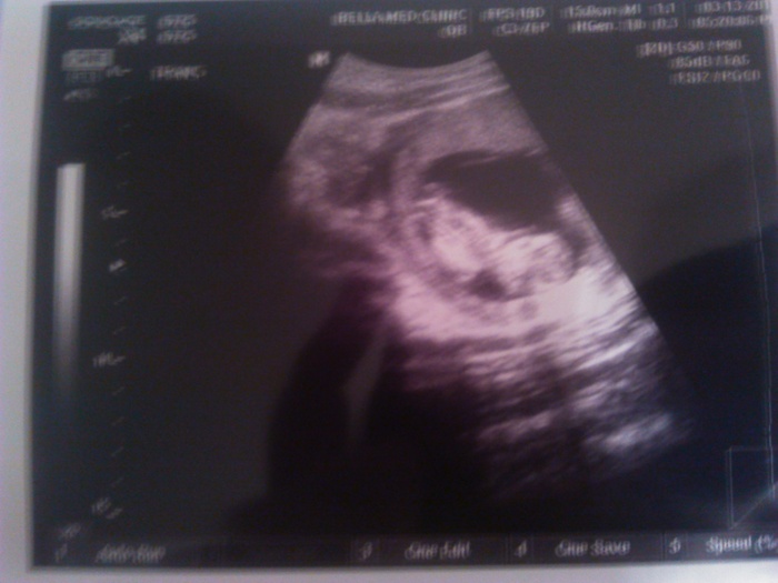 First ultrasound. March 13, 2014.  (3 months•5 days)