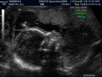 profile of our little girl at 20 weeks