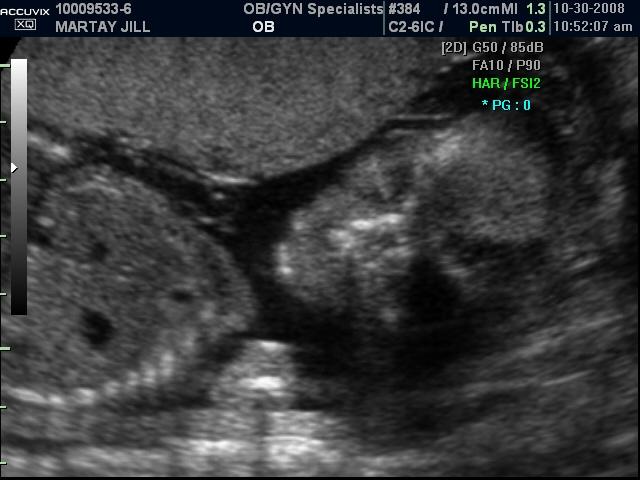 babe's face and spine at 20 weeks