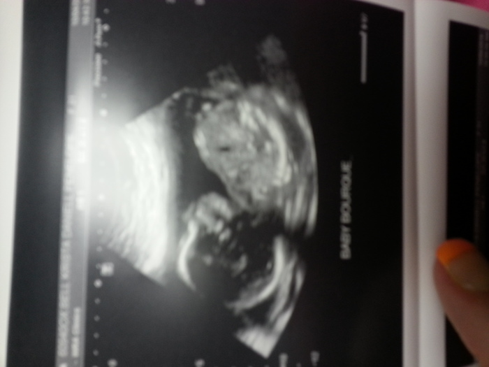 Baby Amelia 20 week ultrasound april 10th 2014