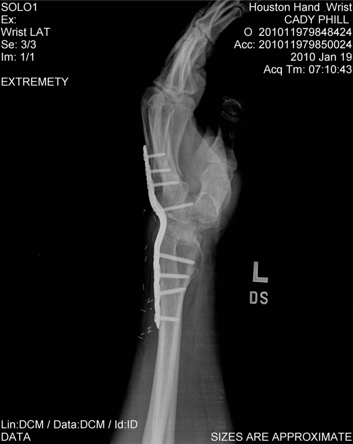 x-rays taken 9 weeks after total wrist fusion