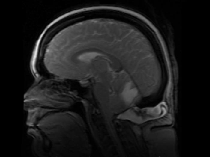 My MRI showing the hydrocephalus, 2 years after decompression surgery.