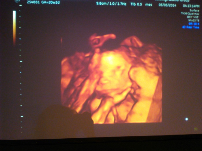 3D Ultrasound. c: