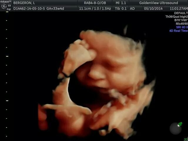 HD 3D ultrasound 33weeks 