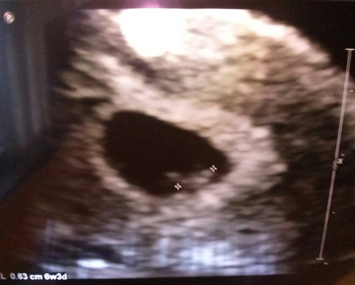 first time I ever seen my son and his tiny heart beat. 