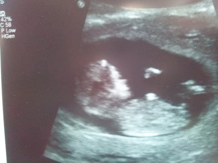 12 weeks and already got daddys nose, poor baby. ♥ 