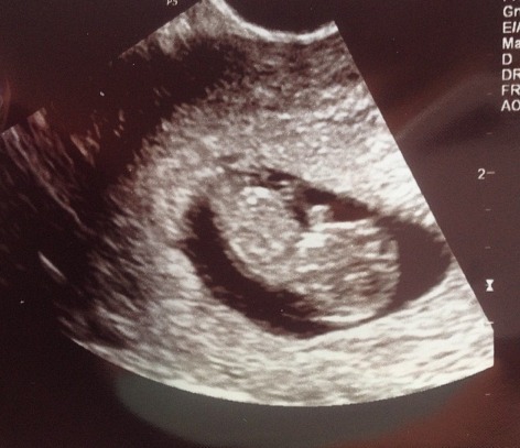 first ultrasound . 12w.2d.