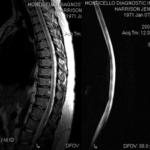 This is a picture of the t-spine with contrast, next to the Myelo scan.