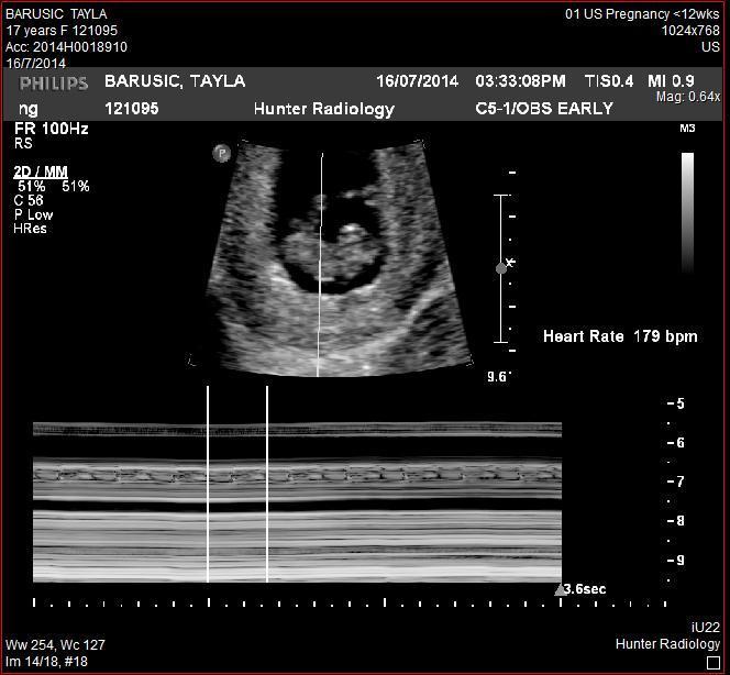 Baby's first heartbeat!