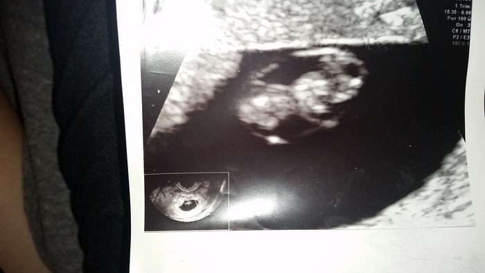 Baby number two at 7 weeks. Coming Jan 13th. :)