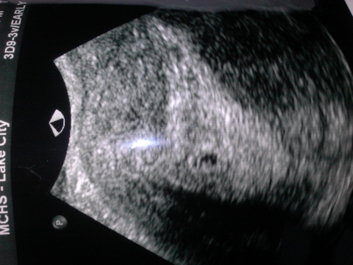 First ultrasound 