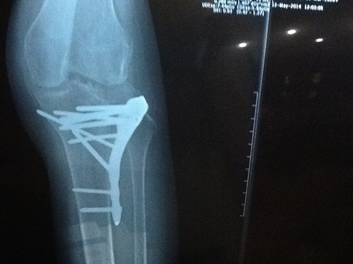 another X-Ray, lots of pins and screws, 2 plates