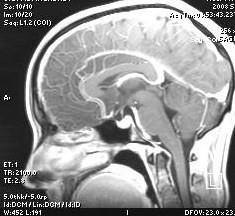 This is one of the view marked by the radiologist as having a lesion present. 