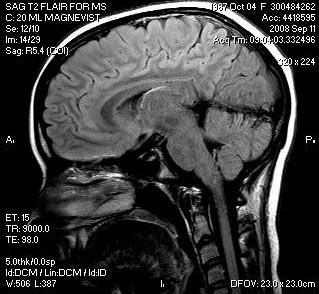 This is the 3 T MRI that I took at NYU. The lesions/patches are in the brainstem