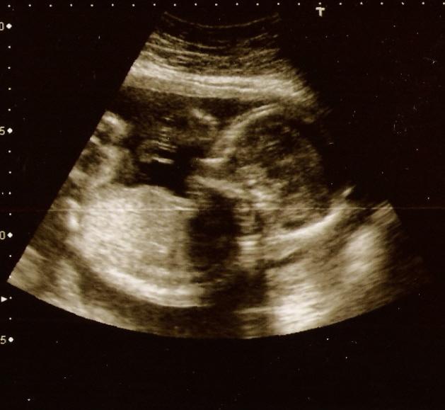 5 month scan