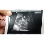 11 week first ultrasound