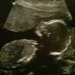 Found Out I'm Having A Girl ♡ :) (19 Weeks)