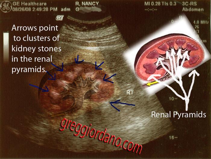 I photoshoped a Kidney drawing over my kidney ultrasound.  See how the pockets of stones  line up