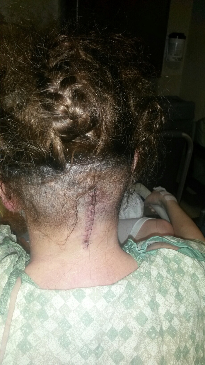 my stitches. I hope to get them out March 26, 2015