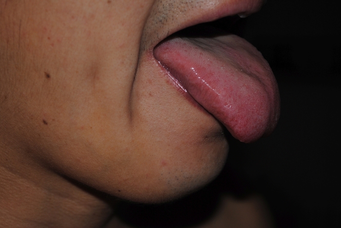 Xerostomia and swollen tongue, April 2015