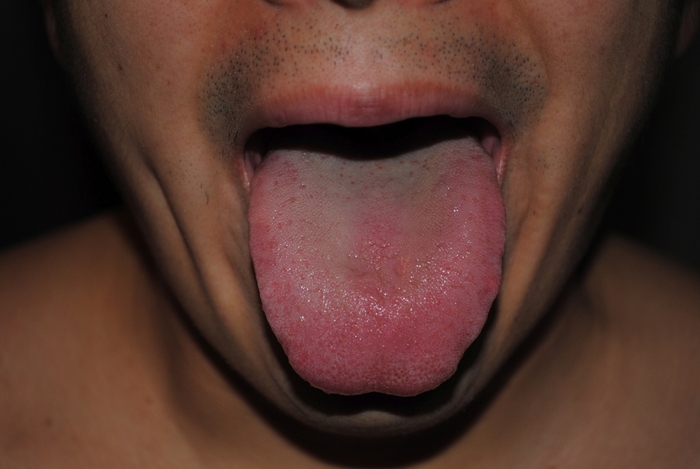 Xerostomia, April 2015. Notice the very little saliva in the tongue