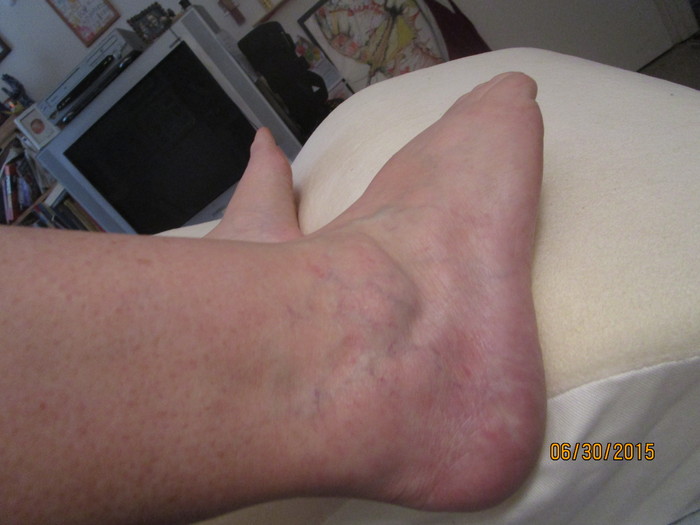 more swelling