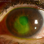 Central corneal abrasion (green dye shows it)