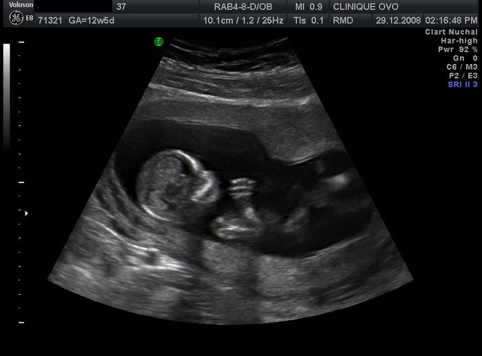 Nt ultrasound (12 weeks 5 days)... it's a boy!