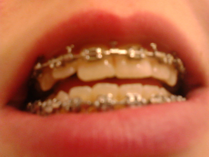 Before surgery teeth